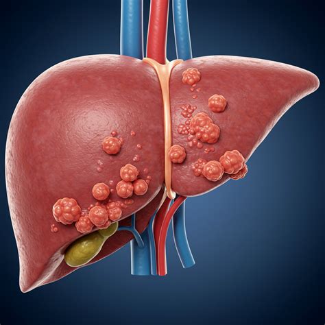 Adenocarcinom metastaser